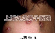 梅毒前期症状图片_上海九龙男子医院